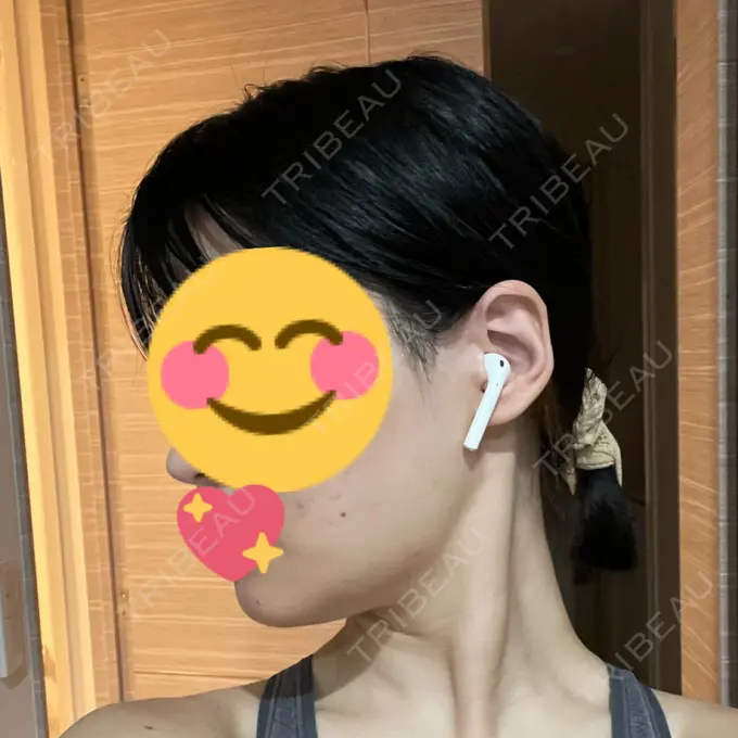 骨切り（あご） / 骨削り（エラ） / 骨削り（頬） よこはまエーブクリニック DAY 986 メイン用