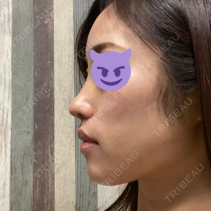 鼻中隔延長（切開） / 小鼻縮小（切開） みずほクリニック DAY 7 メイン用