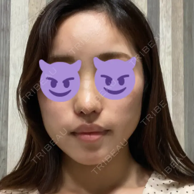 鼻中隔延長（切開） / 小鼻縮小（切開） みずほクリニック DAY 7 メイン用