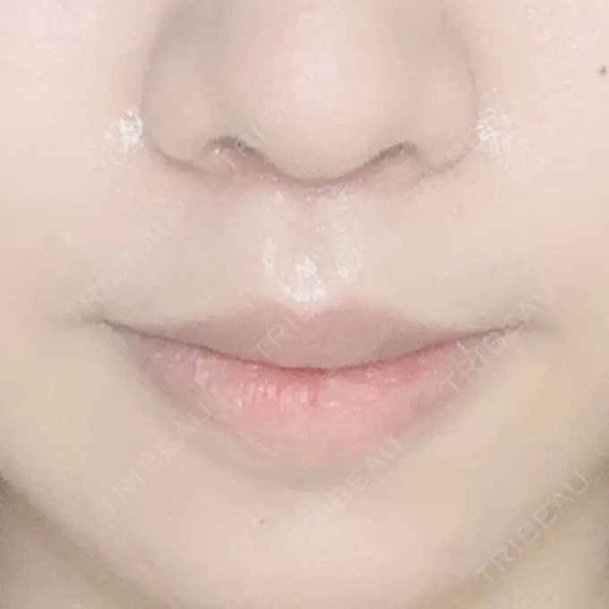 人中短縮 / ボトックス（口角） 新宿ラクル美容外科クリニック 新宿院 DAY 35 メイン用