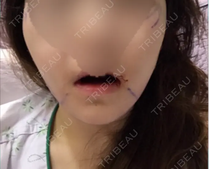 骨切り（あご） / 骨削り（エラ） / 骨削り（頬） id（アイディ）美容外科 DAY 1 メイン用