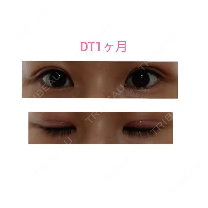 二重切開 / 眼瞼下垂（切開） 城本クリニック 福岡院 DAY 31 メイン用