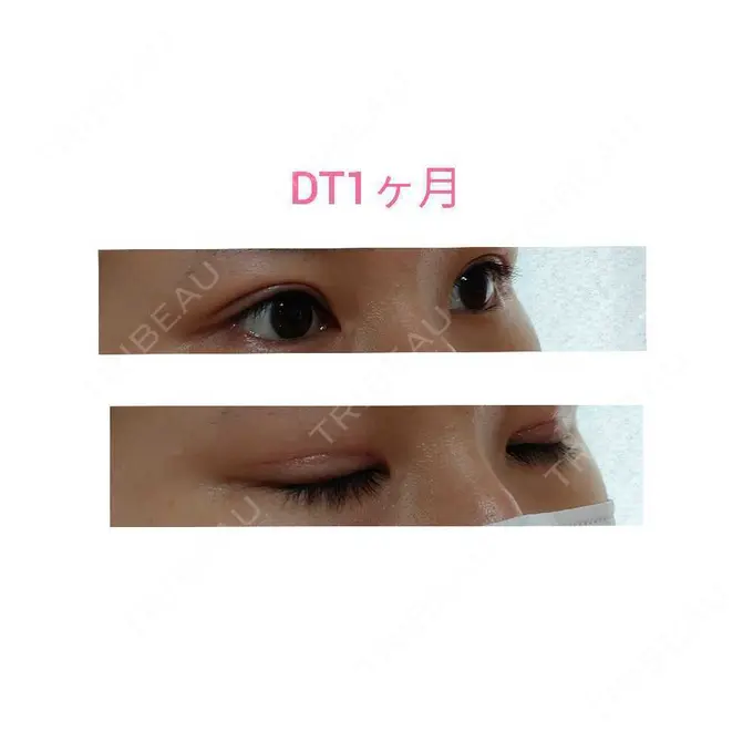 二重切開 / 眼瞼下垂（切開） 城本クリニック 福岡院 DAY 31 メイン用