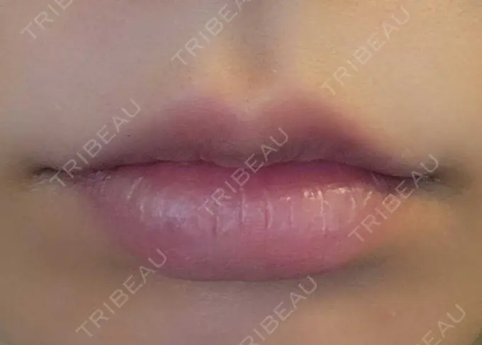 アートメイク（唇） エイトビューティークリニック 新宿院 DAY 44 メイン用