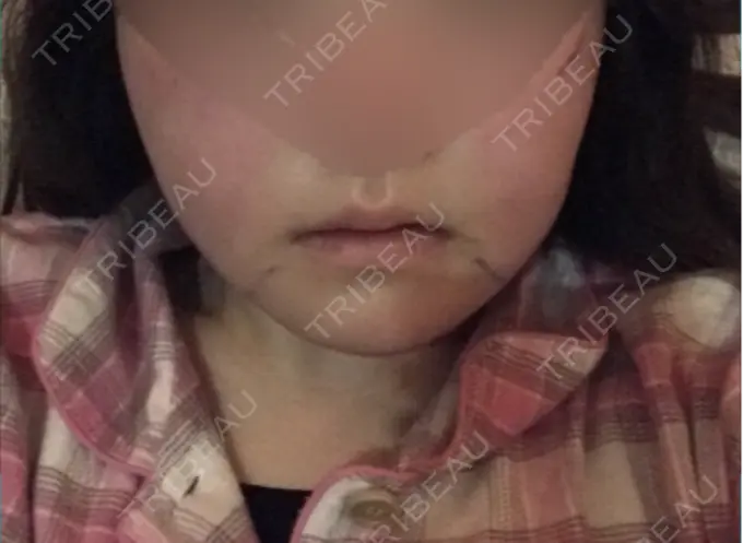 骨切り（あご） / 骨削り（エラ） / 骨削り（頬） id（アイディ）美容外科 DAY 1 メイン用