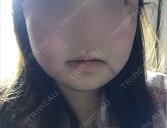 骨切り（あご） / 骨削り（エラ） / 骨削り（頬） id（アイディ）美容外科 DAY 2 メイン用