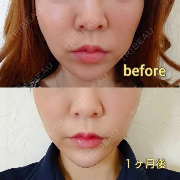 糸リフト MIL CLINIC OSAKA AFTER メイン用