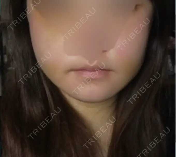 骨切り（あご） / 骨削り（エラ） / 骨削り（頬） id（アイディ）美容外科 DAY 7 メイン用