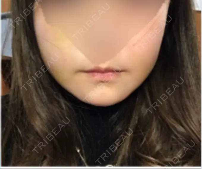 骨切り（あご） / 骨削り（エラ） / 骨削り（頬） id（アイディ）美容外科 DAY 14 メイン用