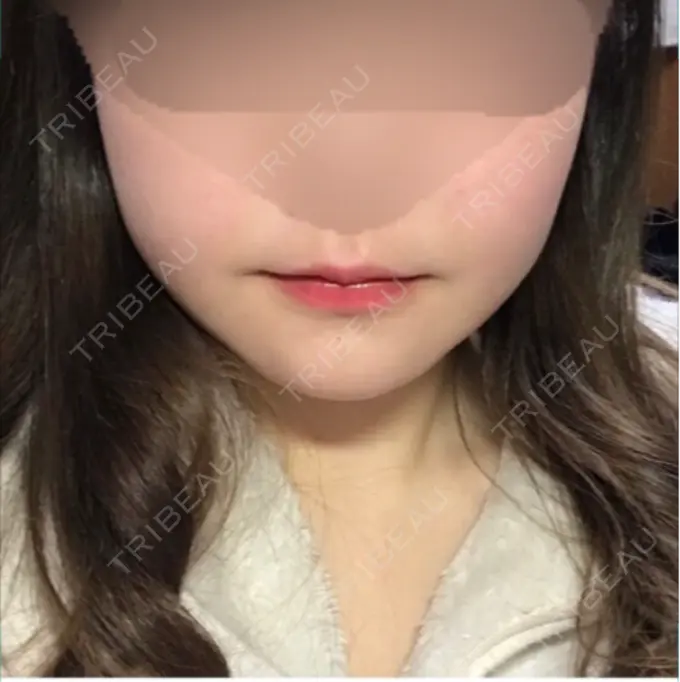 骨切り（あご） / 骨削り（エラ） / 骨削り（頬） id（アイディ）美容外科 AFTER メイン用