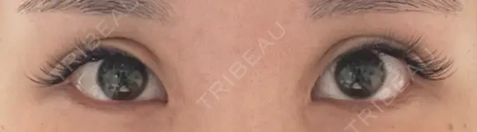 二重切開 / 蒙古ひだ形成 R.O.clinic DAY 72 メイン用