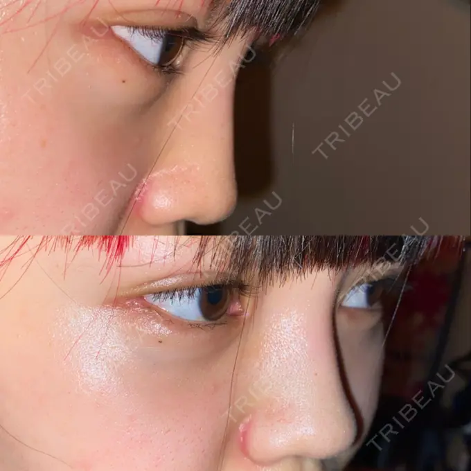 ヒアルロン酸注入（鼻） / ヒアルロン酸注入（あご） 神戸元町ビューティークリニック AFTER メイン用