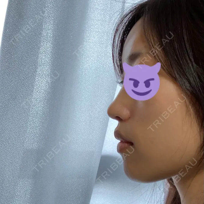 鼻中隔延長（切開） / 小鼻縮小（切開） みずほクリニック DAY 17 メイン用