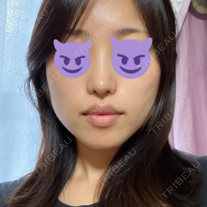 鼻中隔延長（切開） / 小鼻縮小（切開） みずほクリニック DAY 17 メイン用