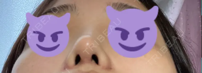 鼻中隔延長（切開） / 小鼻縮小（切開） みずほクリニック DAY 17 メイン用