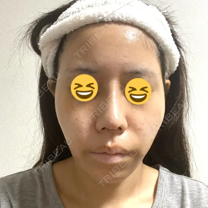 隆鼻術 / 鼻中隔延長（切開） みずほクリニック DAY 5 メイン用