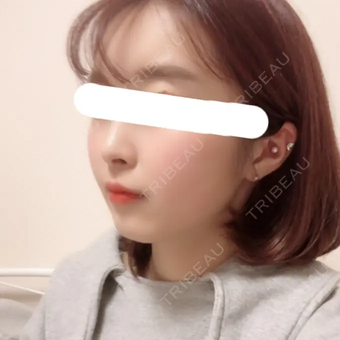 骨削り（頬） ボンディ美容整形外科（旧リオン整形外科） DAY 258 メイン用