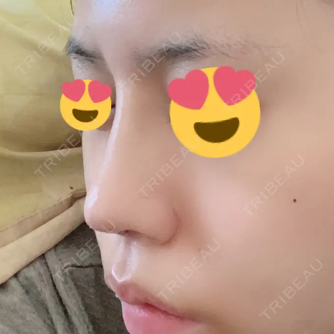 隆鼻術 / 鼻中隔延長（切開） みずほクリニック DAY 6 メイン用