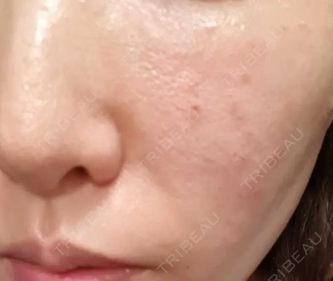 ベビーコラーゲン CLASSY 仙台美容外科・美容皮膚科 DAY 19 メイン用