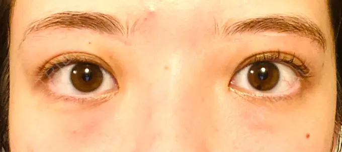 眉下切開 Taide Suenaga Clinic（タイデスエナガクリニック） DAY 239 メイン用