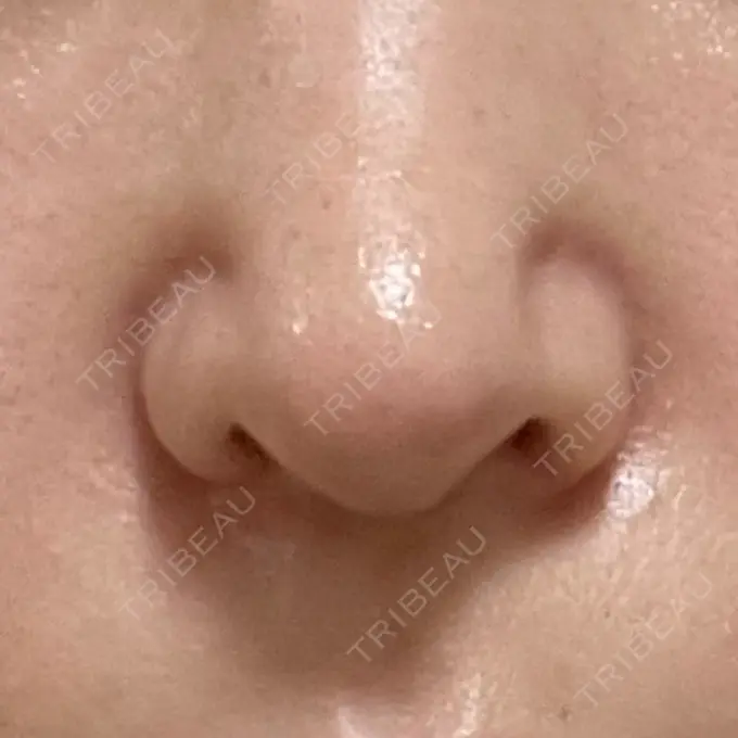 鼻中隔延長（切開） / 小鼻縮小（切開） / 軟骨移植 牧野美容クリニック DAY 30 メイン用