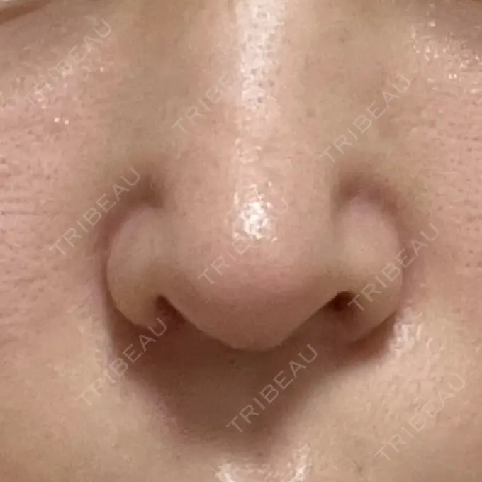 鼻中隔延長（切開） / 小鼻縮小（切開） / 軟骨移植 牧野美容クリニック DAY 31 メイン用