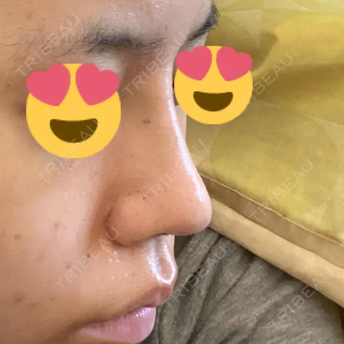 隆鼻術 / 鼻中隔延長（切開） みずほクリニック DAY 7 メイン用