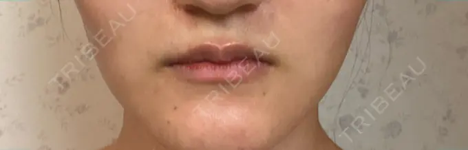 ボトックス（エラ・小顔） TCB東京中央美容外科 福岡天神院 AFTER メイン用