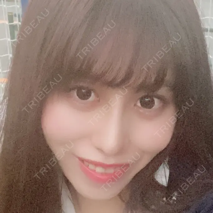 隆鼻術 / 鼻中隔延長（切開） みずほクリニック DAY 11 メイン用