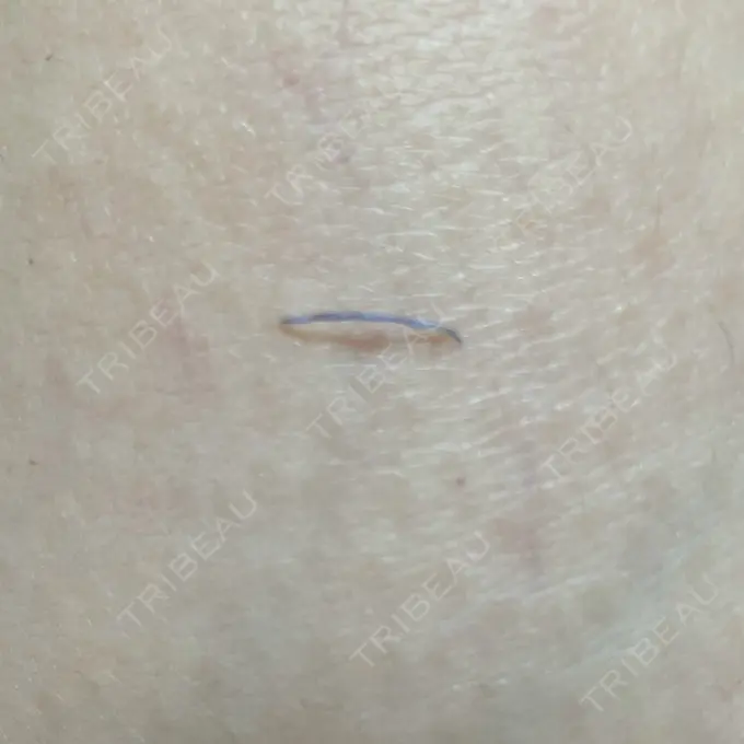 鼻中隔延長（切開） / 小鼻縮小（切開） / 軟骨移植 牧野美容クリニック DAY 38 メイン用