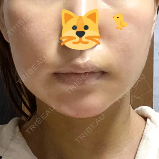 糸リフト / 脂肪吸引（顔） / メーラーファット除去 / 脂肪注入（輪郭） 湘南美容クリニック 秋葉原院 DAY 6 メイン用