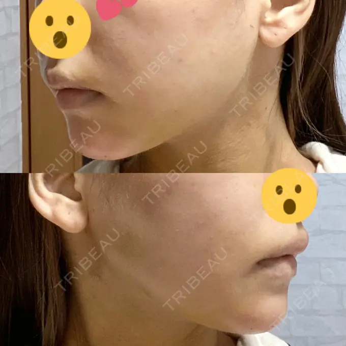 糸リフト / 脂肪吸引（顔） / メーラーファット除去 / 脂肪注入（輪郭） 湘南美容クリニック 秋葉原院 DAY 6 メイン用