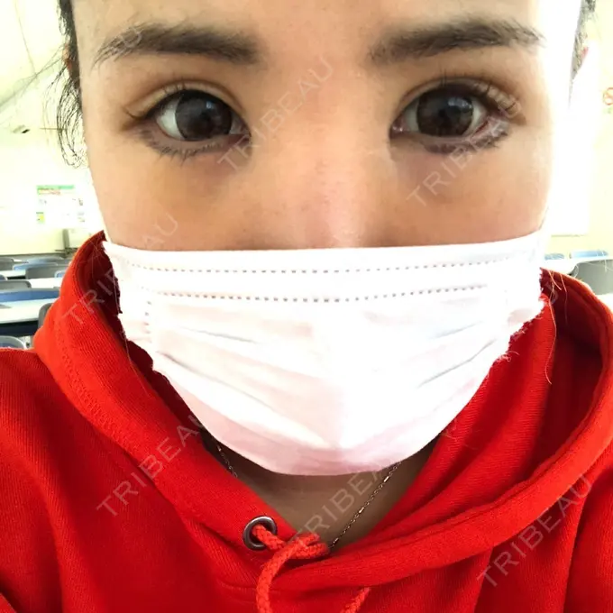 目尻切開 / タレ目形成・グラマラスライン（切開） 品川美容外科 横浜院（※品川スキンクリニック提携） DAY 7 メイン用