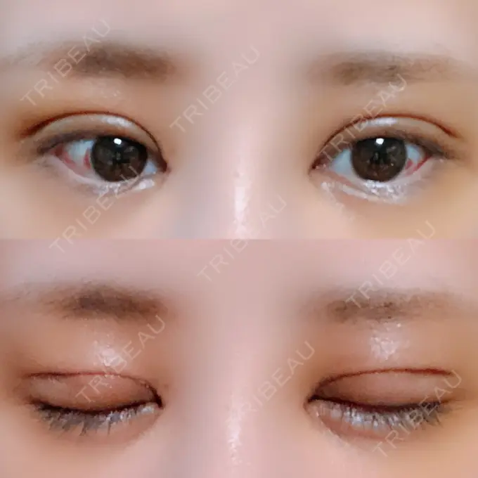 二重切開 / 目頭切開 / ヒアルロン酸注入（涙袋） FROM B整形外科 (旧バウム整形外科) DAY 6 メイン用