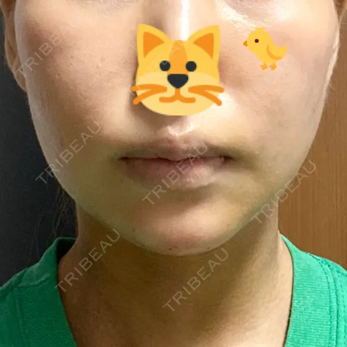 糸リフト / 脂肪吸引（顔） / メーラーファット除去 / 脂肪注入（輪郭） 湘南美容クリニック 秋葉原院 DAY 7 メイン用