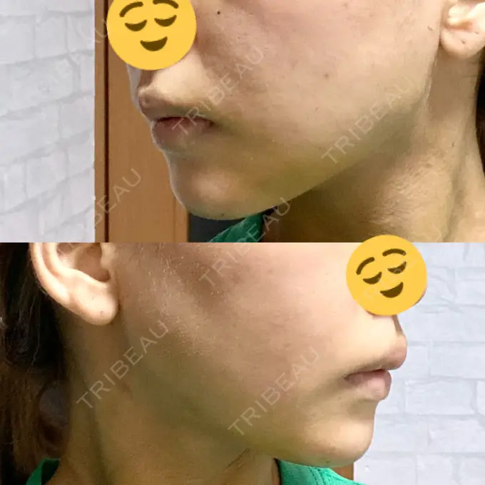 糸リフト / 脂肪吸引（顔） / メーラーファット除去 / 脂肪注入（輪郭） 湘南美容クリニック 秋葉原院 DAY 7 メイン用