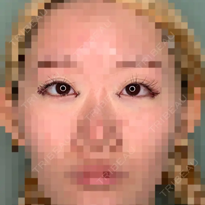 目頭切開 / 目尻切開 くさのたろうクリニック DAY 0 メイン用