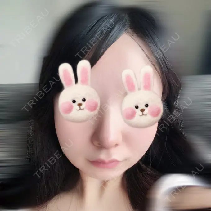 鼻尖形成（切開） / 軟骨移植 / 鼻尖縮小 / その他（鼻） みずほクリニック DAY 6 メイン用