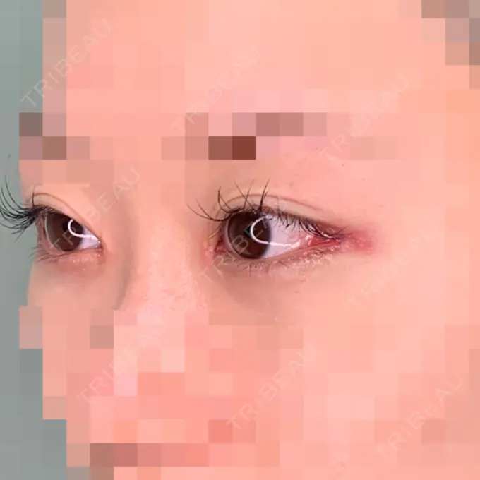 目頭切開 / 目尻切開 くさのたろうクリニック DAY 7 メイン用