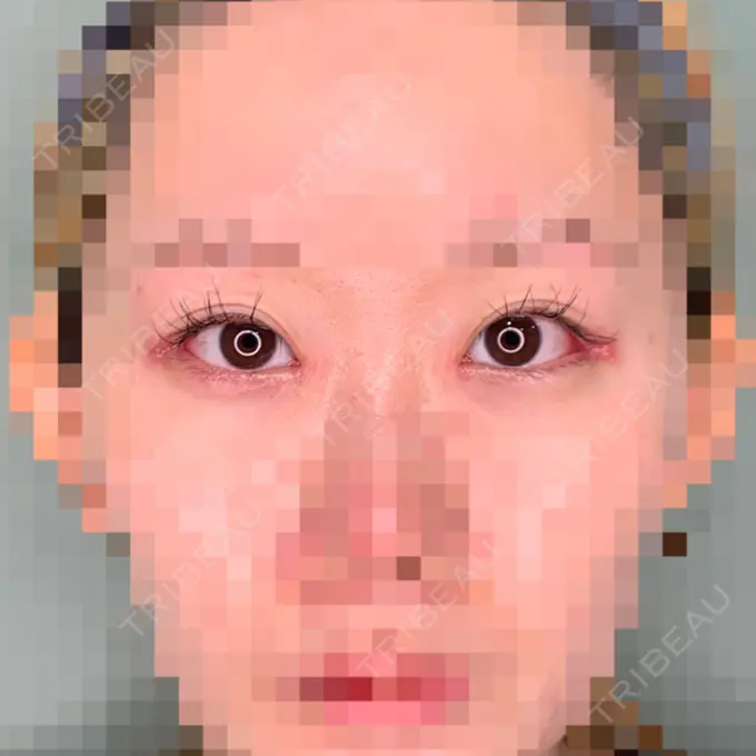 目頭切開 / 目尻切開 くさのたろうクリニック DAY 7 メイン用