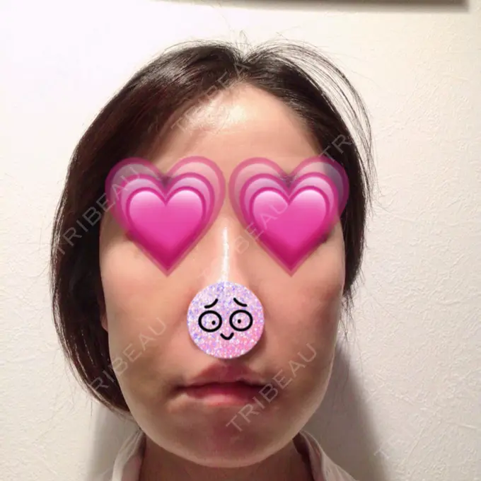 糸リフト / バッカルファット除去 / 脂肪吸引（顔） / メーラーファット除去 / ジョールファット除去 / ボトックス（エラ・小顔） / その他（輪郭） 湘南美容クリニック 秋葉原院 DAY 9 メイン用