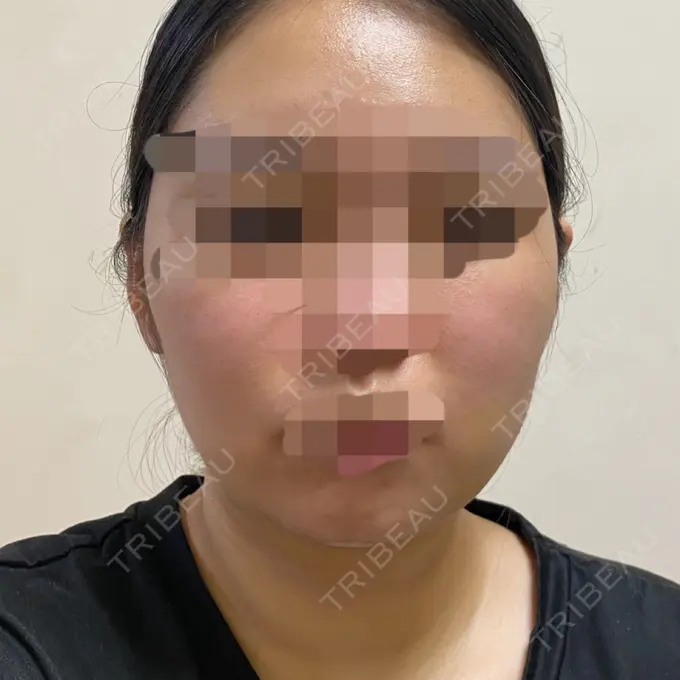 脂肪吸引（顔） THE CLINIC（ザ・クリニック） 福岡院 DAY 8 メイン用