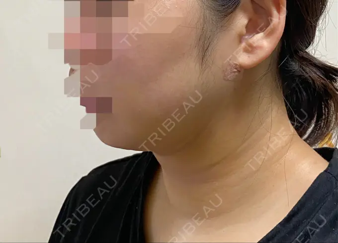 脂肪吸引（顔） THE CLINIC（ザ・クリニック） 福岡院 DAY 8 メイン用