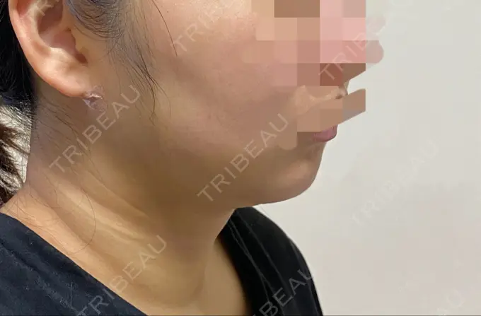 脂肪吸引（顔） THE CLINIC（ザ・クリニック） 福岡院 DAY 8 メイン用