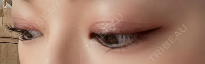 二重切開 湘南美容クリニック 藤沢院 DAY 93 メイン用