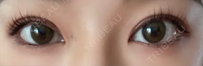 二重切開 湘南美容クリニック 藤沢院 AFTER メイン用