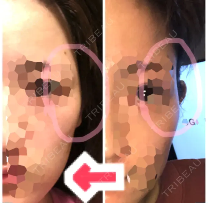 ヒアルロン酸注入（こめかみ） ルラ美容クリニック 渋谷本院 DAY 160 メイン用