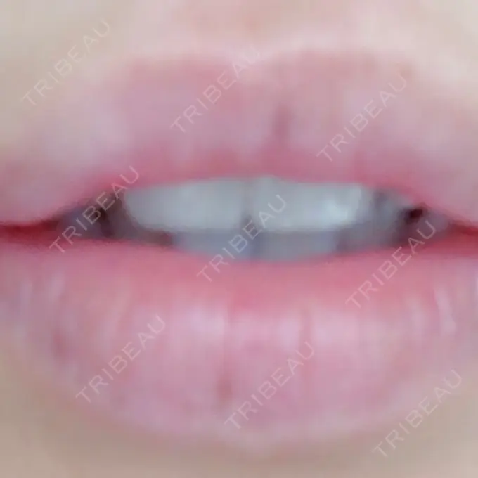 人中短縮 / その他（口元） eクリニック 金沢本院 DAY 184 メイン用