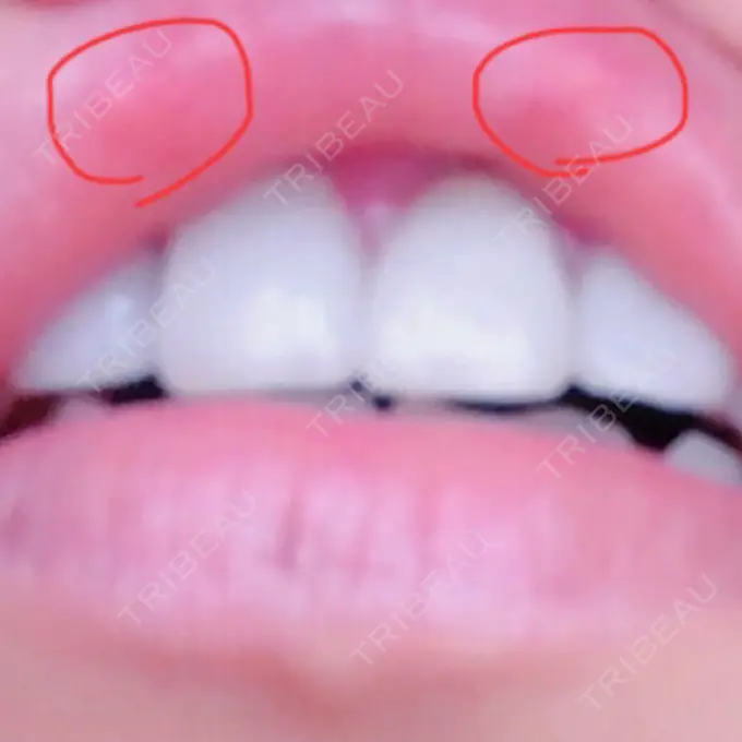 人中短縮 / その他（口元） eクリニック 金沢本院 DAY 184 メイン用