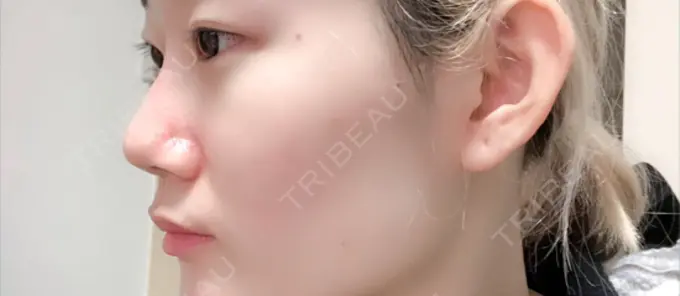 レディエッセ注入（鼻） 赤坂プレミアクリニック DAY 0 メイン用